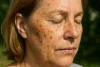 Zonnevlekken in het gezicht: oorzaken, herkenning en behandeling